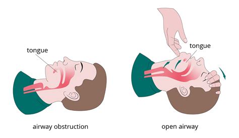 A – Airway – A légutak kérdése